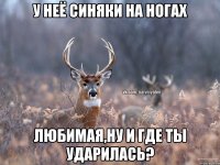 У НЕЁ СИНЯКИ НА НОГАХ ЛЮБИМАЯ,НУ И ГДЕ ТЫ УДАРИЛАСЬ?